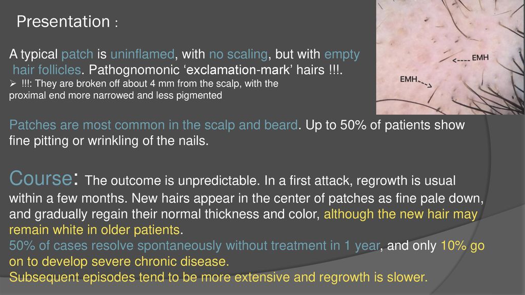 Alopecia Areata Telogen effluvium - ppt download Alopecia Areata Telogen effluvium - ppt download