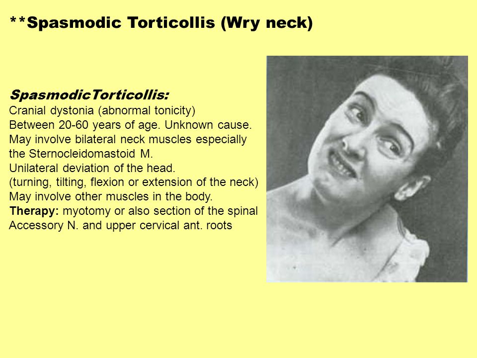 **Spasmodic+Torticollis+(Wry+neck).jpg