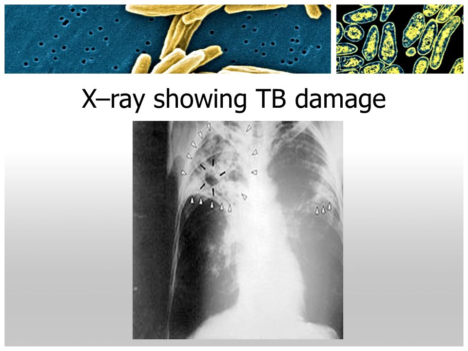 X–ray showing TB damage
