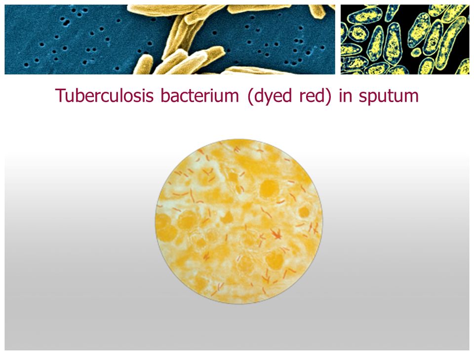 Tuberculosis bacterium (dyed red) in sputum