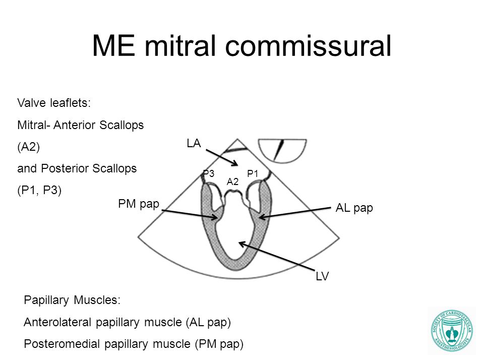 ME mitral commissural Valve leaflets: Mitral- Anterior Scallops (A2)