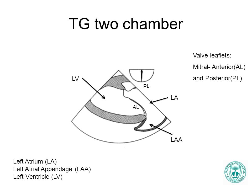 TG two chamber Valve leaflets: Mitral- Anterior(AL) and Posterior(PL)