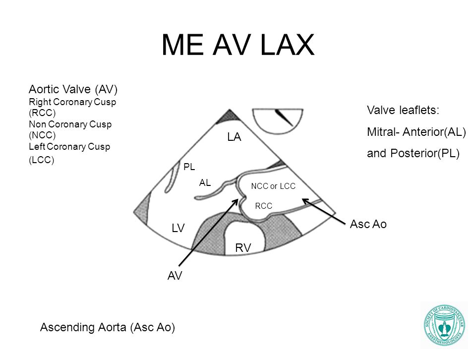 ME AV LAX Aortic Valve (AV) Valve leaflets: Mitral- Anterior(AL)