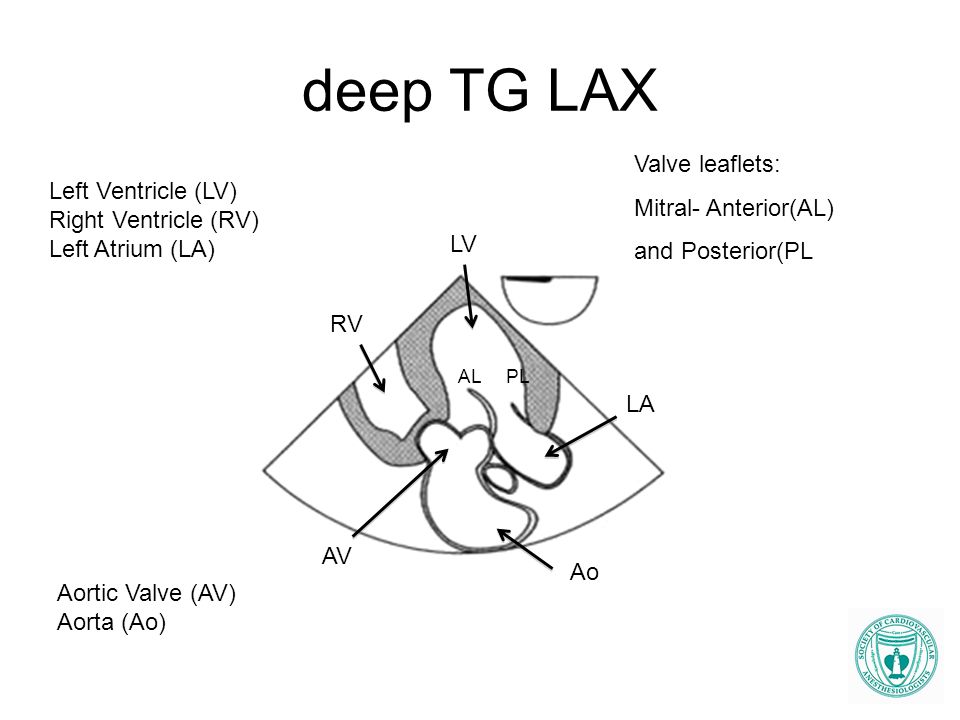 deep TG LAX Valve leaflets: Mitral- Anterior(AL) Left Ventricle (LV)