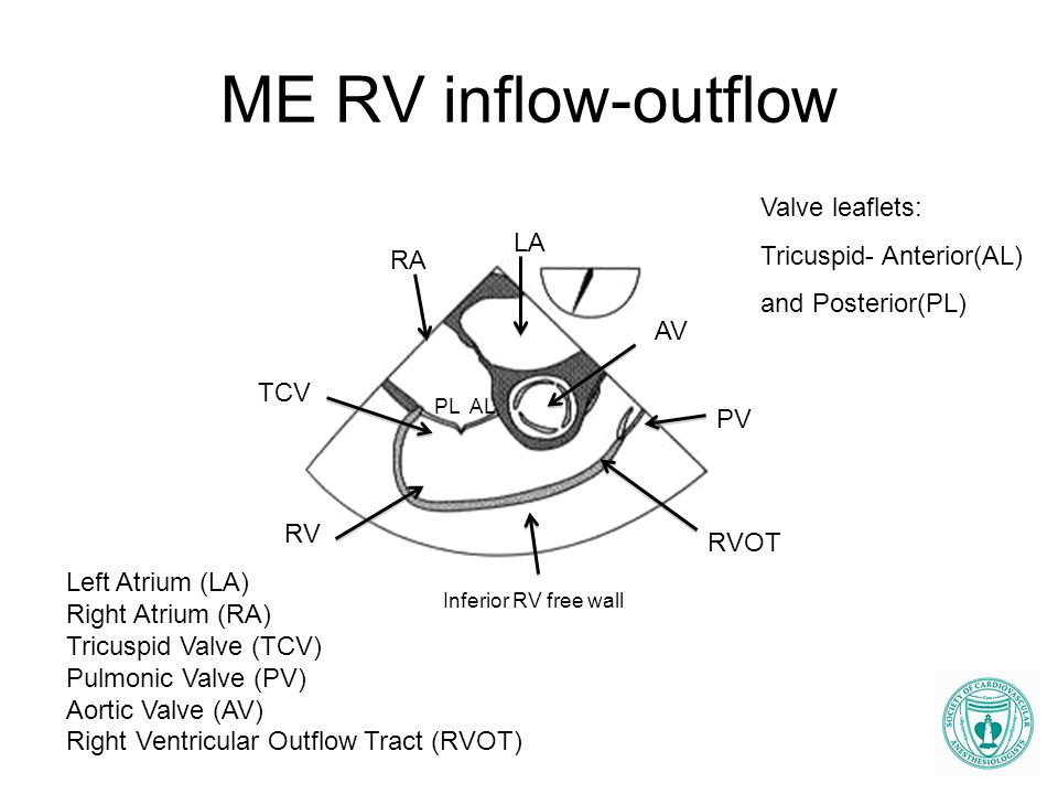 ME RV inflow-outflow Valve leaflets: Tricuspid- Anterior(AL) LA