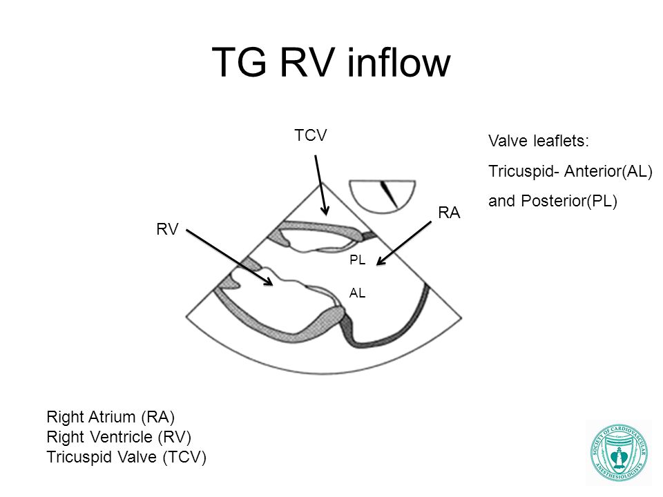 TG RV inflow TCV Valve leaflets: Tricuspid- Anterior(AL)