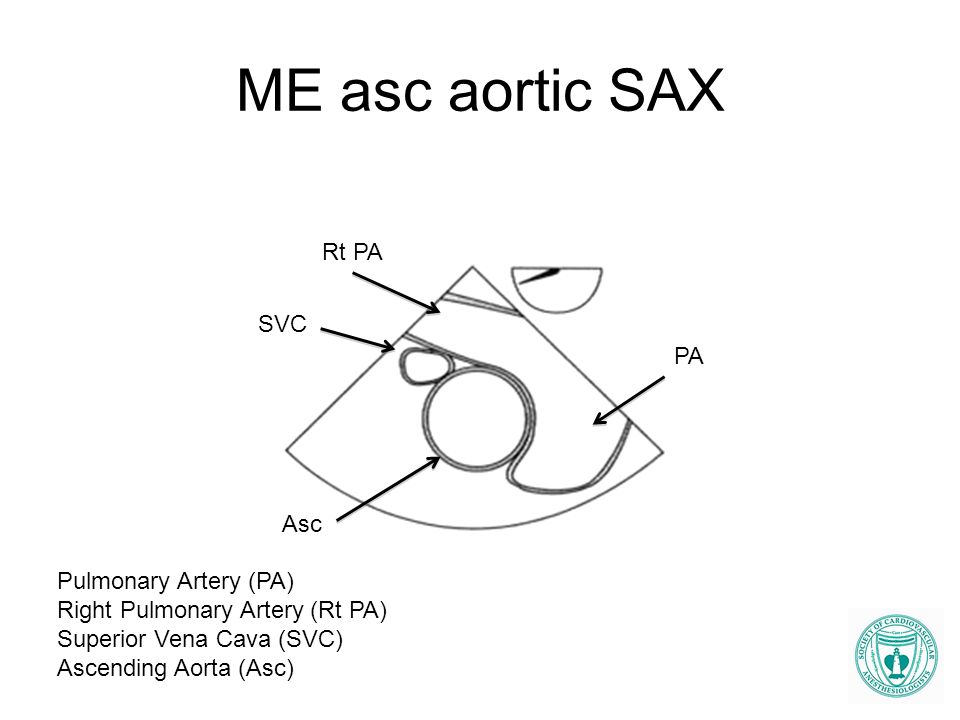 ME asc aortic SAX Rt PA SVC PA Asc Pulmonary Artery (PA)