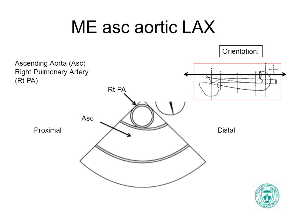 ME asc aortic LAX Orientation: Ascending Aorta (Asc)