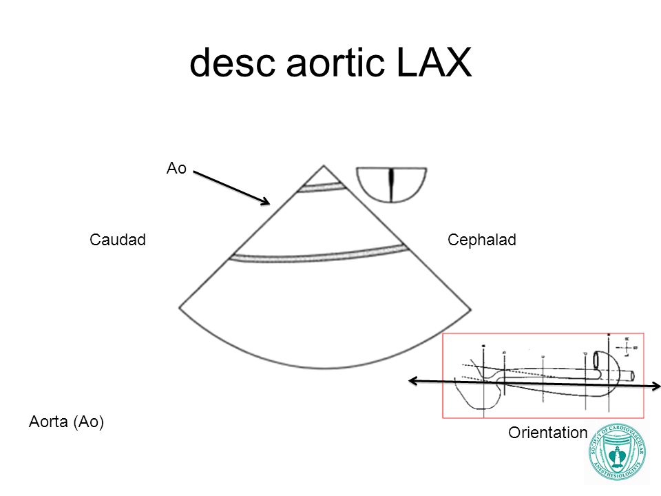 desc aortic LAX Ao Caudad Cephalad Aorta (Ao) Orientation