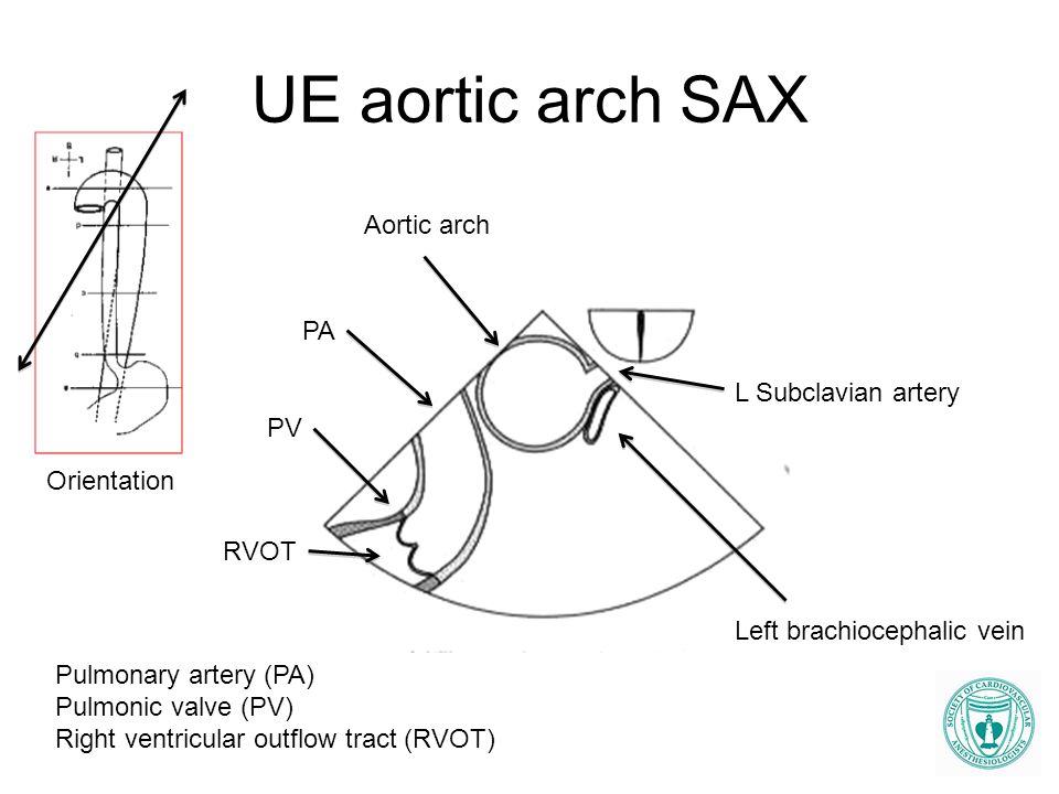 UE aortic arch SAX Aortic arch PA L Subclavian artery PV Orientation