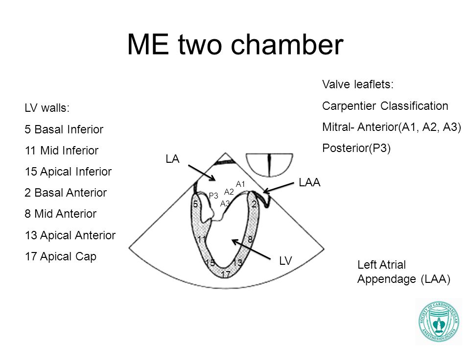 ME two chamber Valve leaflets: Carpentier Classification