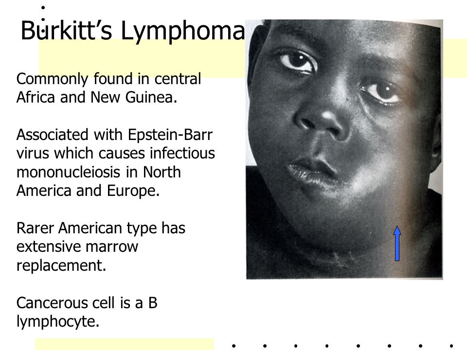 Burkitt’s Lymphoma Commonly found in central Africa and New Guinea.