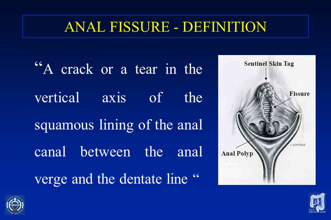 Anal fissure cream
