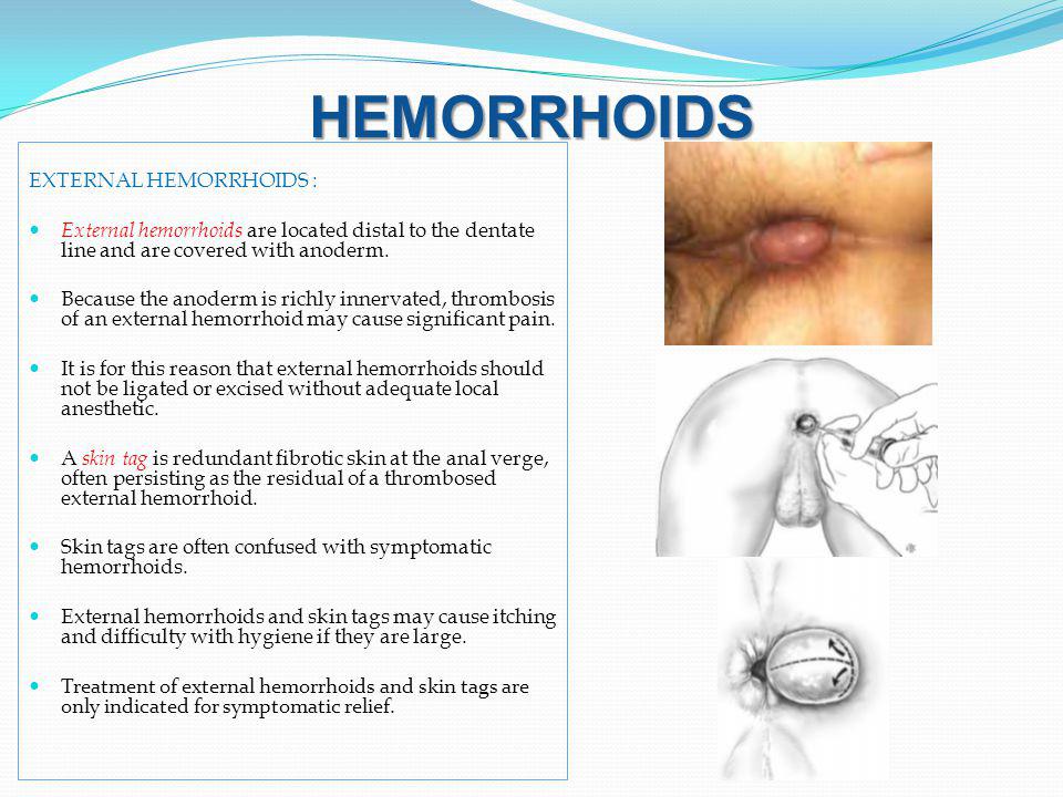 Does Hemorrhoids And Anal Sex