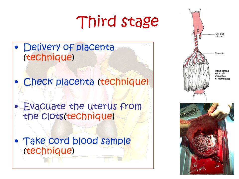 Third stage Delivery of placenta (technique)