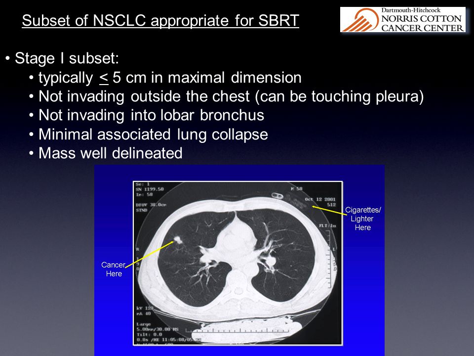 Subset of NSCLC appropriate for SBRT