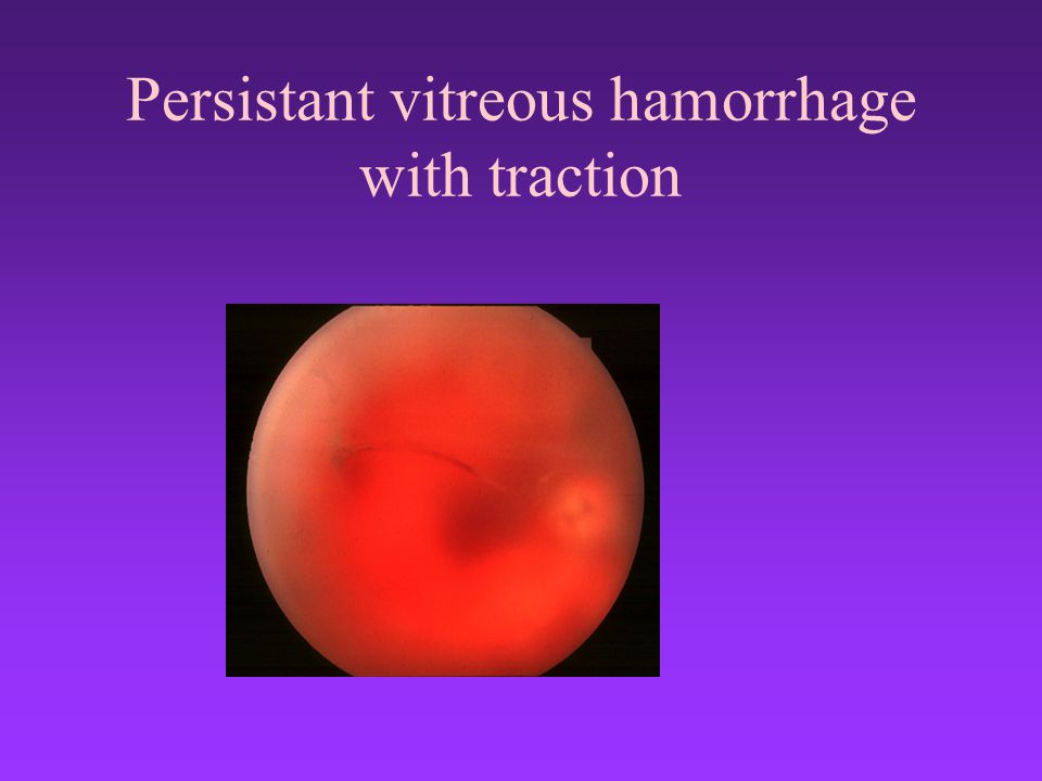 Persistant vitreous hamorrhage with traction