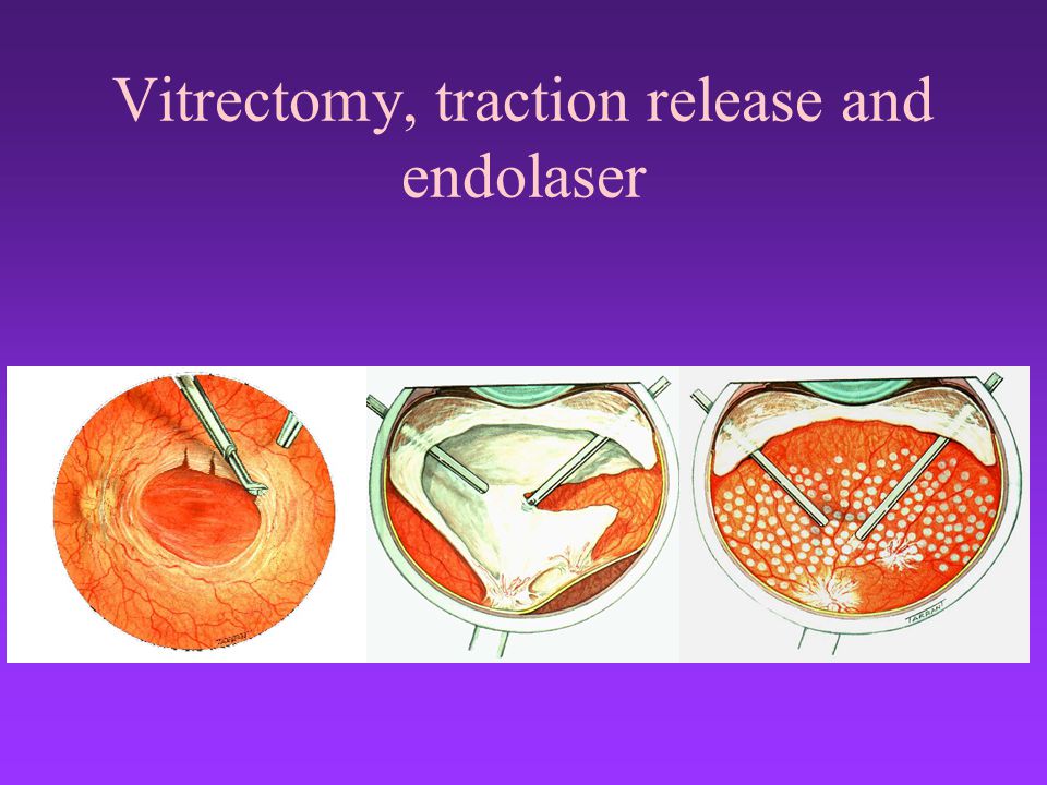 Vitrectomy, traction release and endolaser