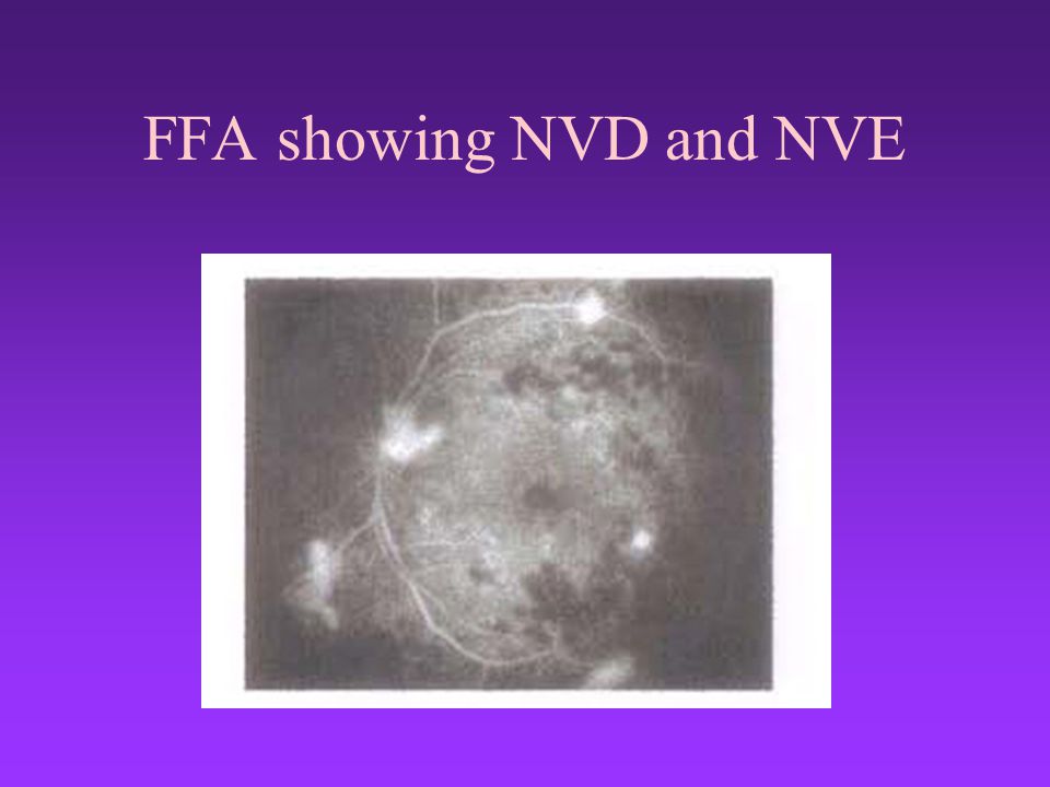 FFA showing NVD and NVE