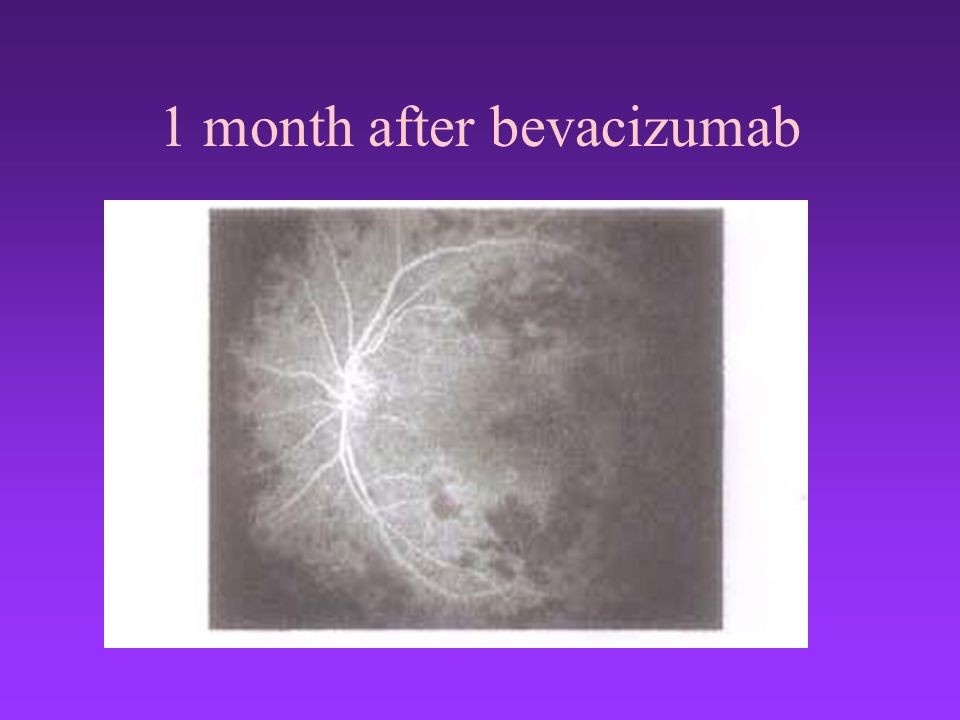 1 month after bevacizumab