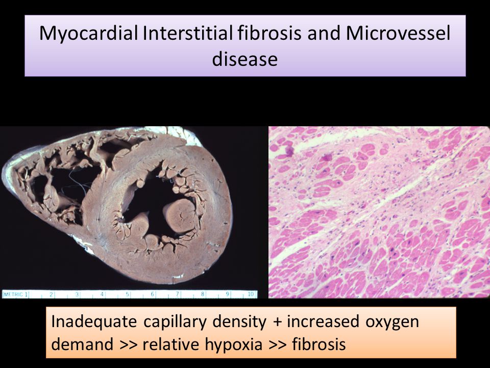 Myocardial Interstitial fibrosis and Microvessel disease
