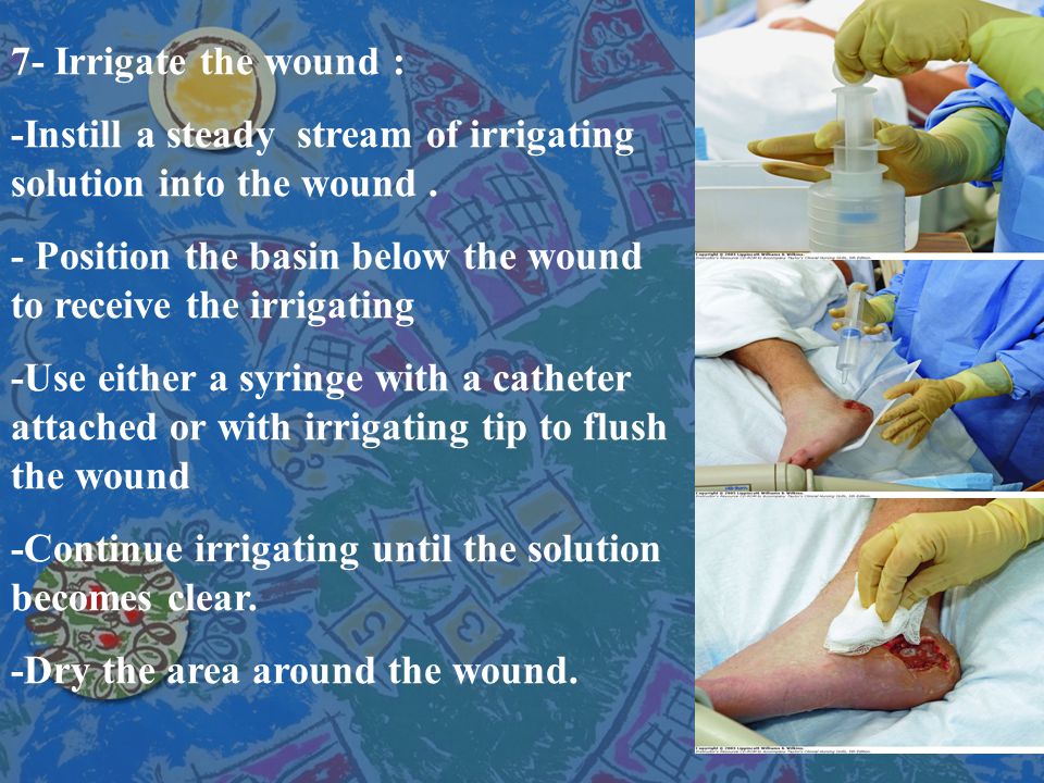 7- Irrigate the wound : -Instill a steady stream of irrigating solution into the wound .