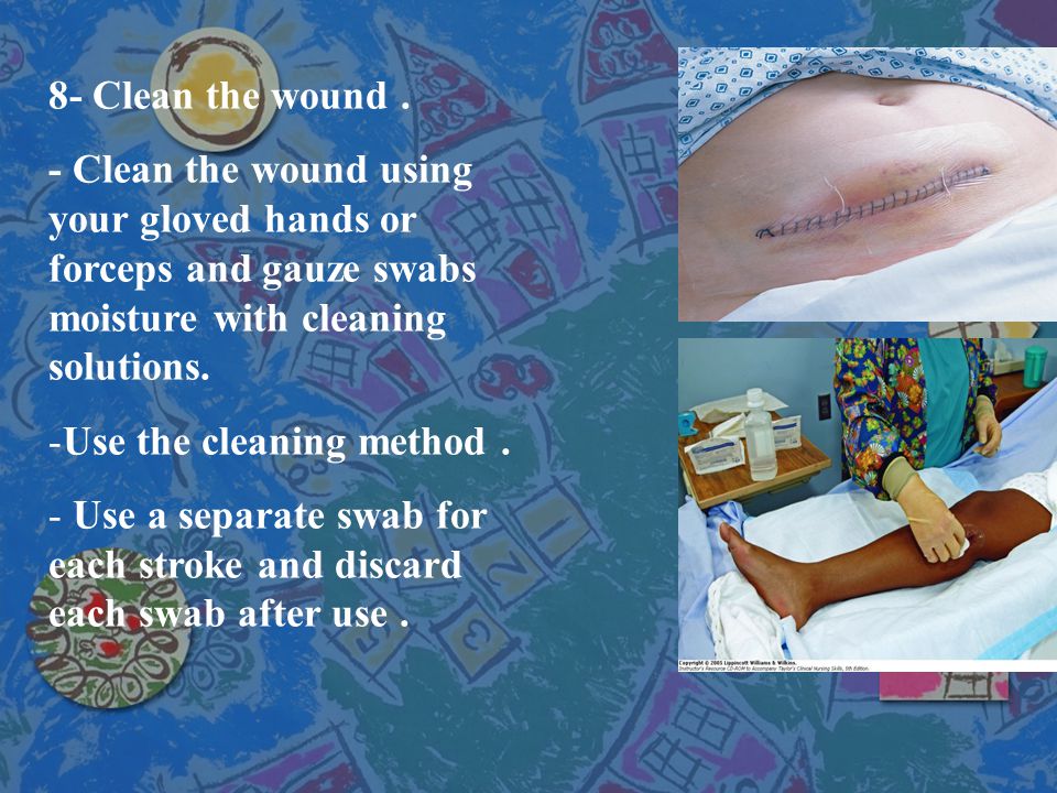 8- Clean the wound . - Clean the wound using your gloved hands or forceps and gauze swabs moisture with cleaning solutions.
