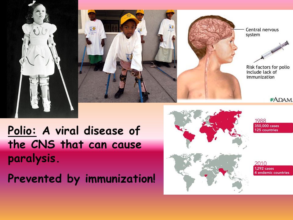 Polio: A viral disease of the CNS that can cause paralysis.