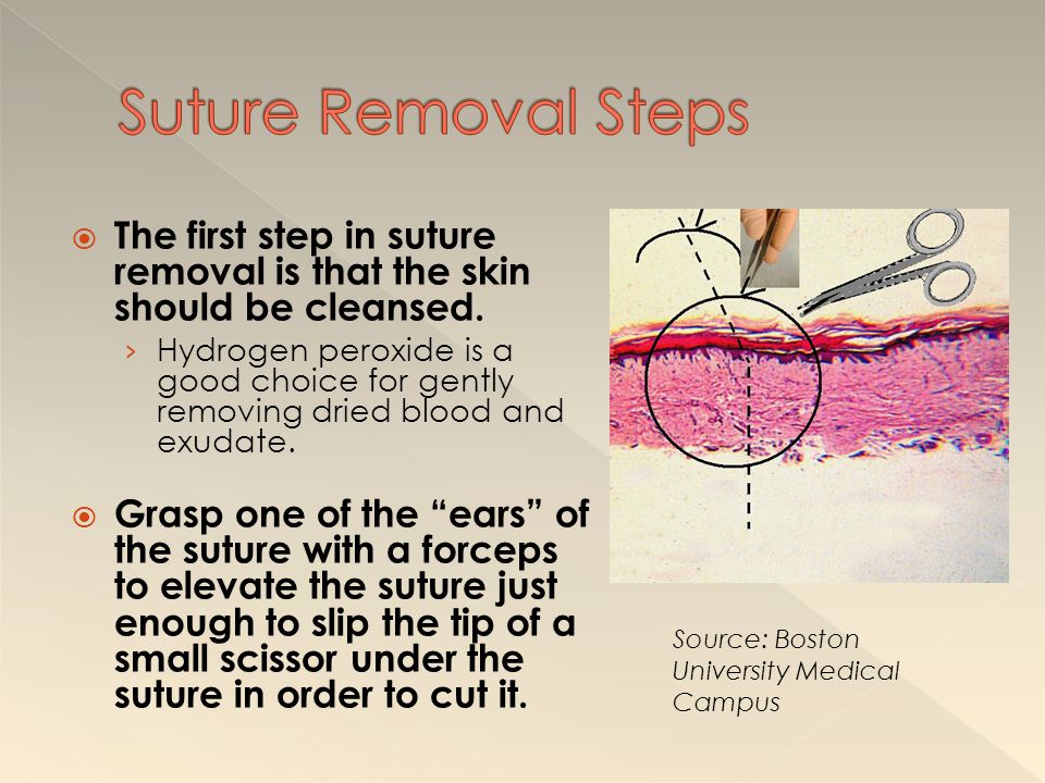 Suture Removal Steps The first step in suture removal is that the skin should be cleansed.