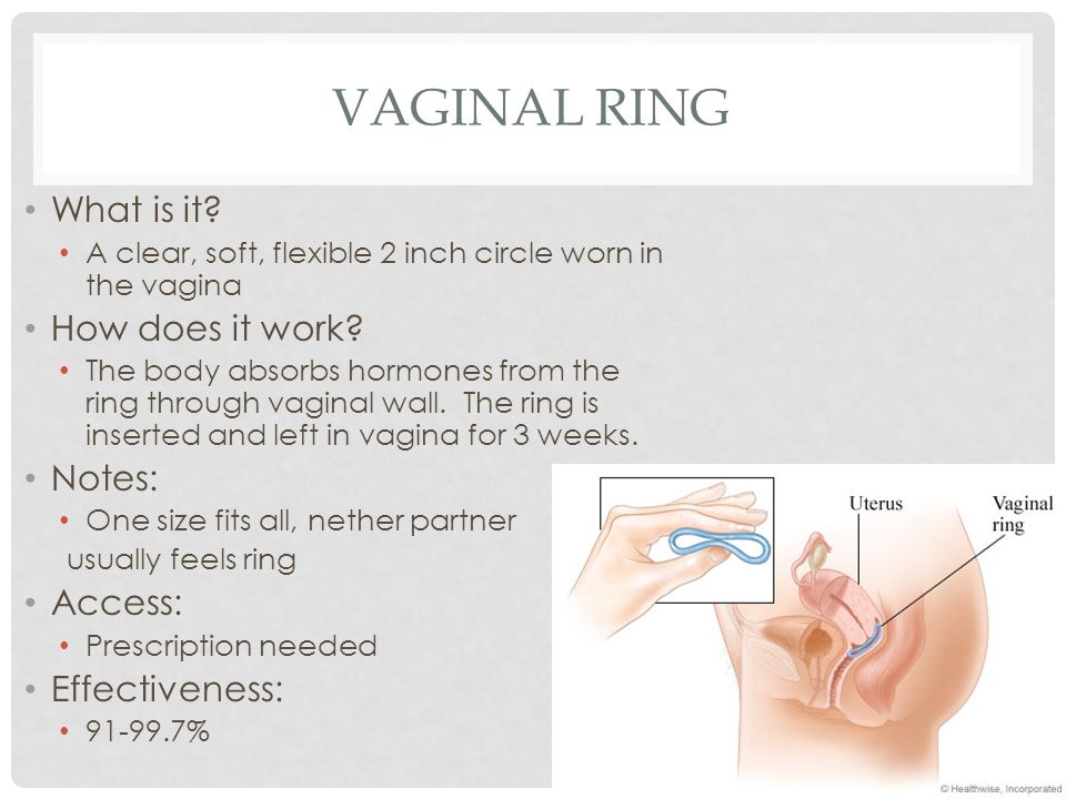 Vaginal ring What is it How does it work Notes: Access: