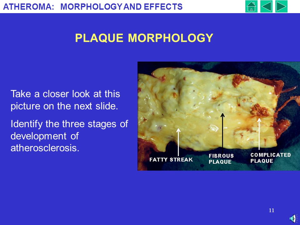 PLAQUE MORPHOLOGY Take a closer look at this picture on the next slide.