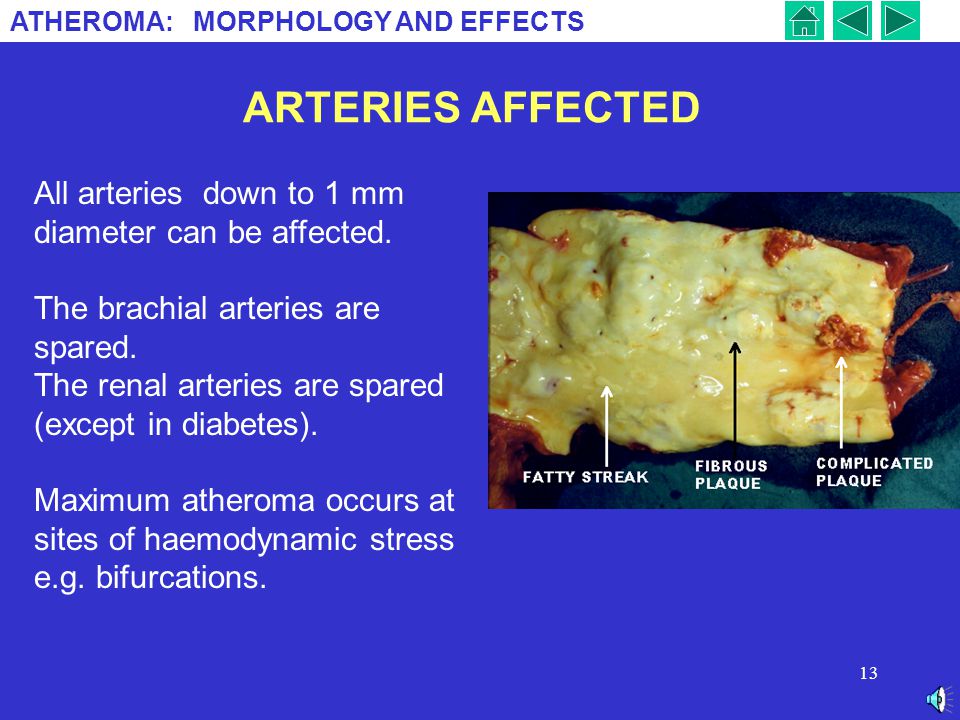 ARTERIES AFFECTED All arteries down to 1 mm diameter can be affected.