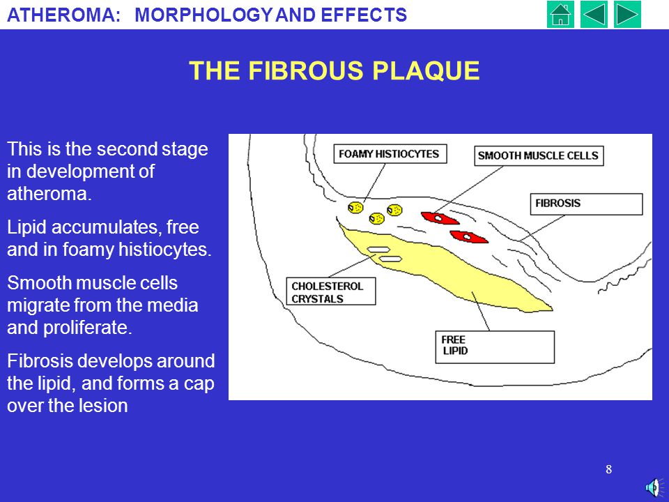 THE FIBROUS PLAQUE This is the second stage in development of atheroma. Lipid accumulates, free and in foamy histiocytes.