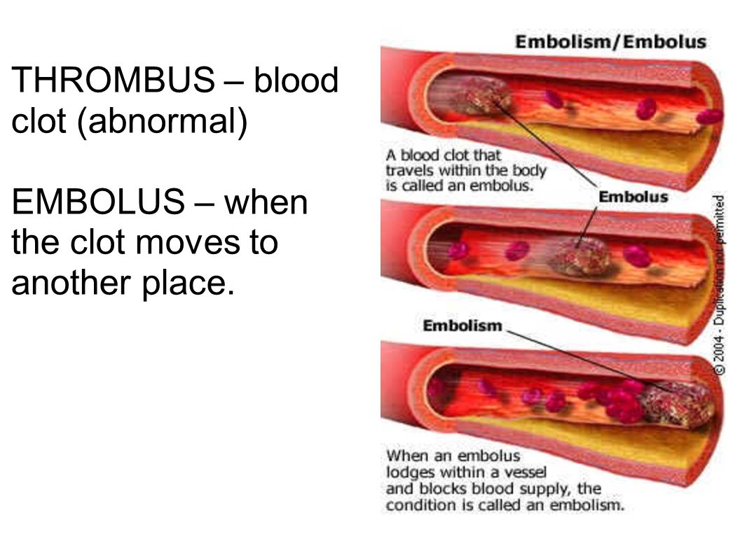 THROMBUS – blood clot (abnormal)