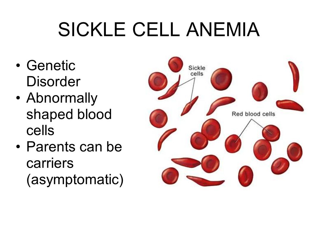 SICKLE CELL ANEMIA Genetic Disorder Abnormally shaped blood cells