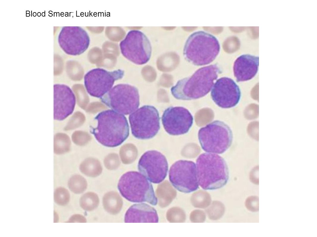Blood Smear; Leukemia