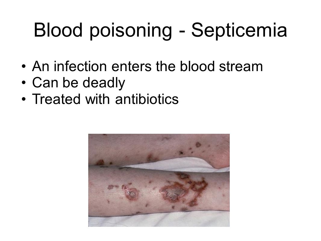 Blood poisoning - Septicemia