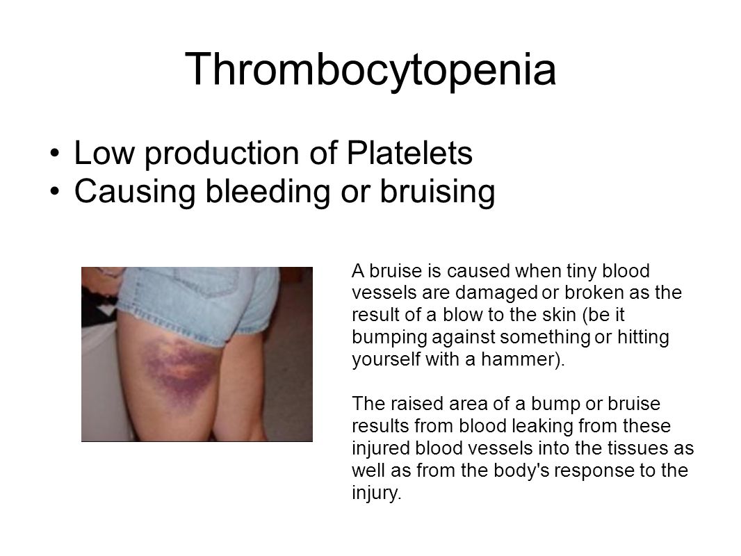 Thrombocytopenia Low production of Platelets