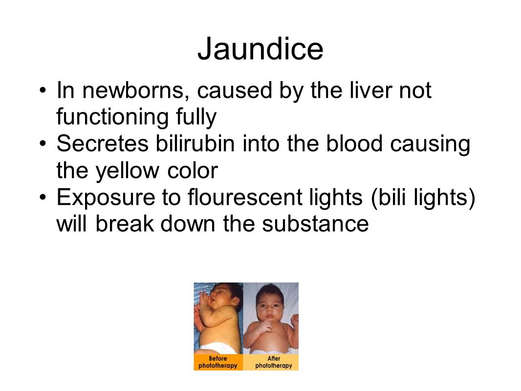 Jaundice In newborns, caused by the liver not functioning fully