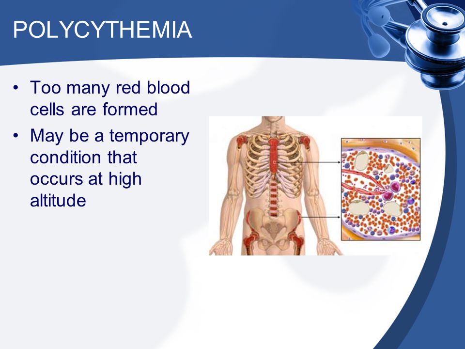 POLYCYTHEMIA Too many red blood cells are formed