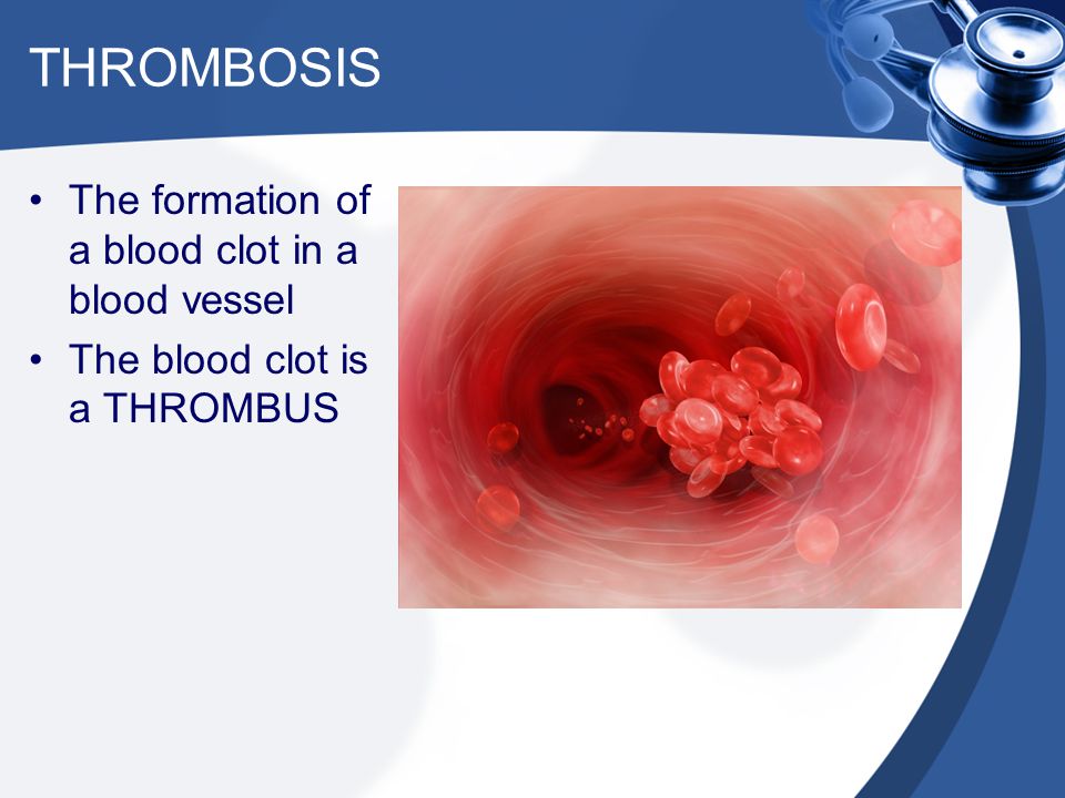 THROMBOSIS The formation of a blood clot in a blood vessel