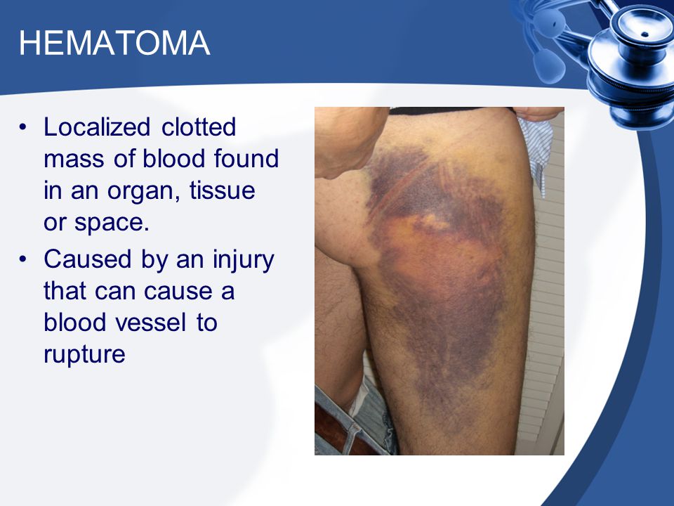 HEMATOMA Localized clotted mass of blood found in an organ, tissue or space.