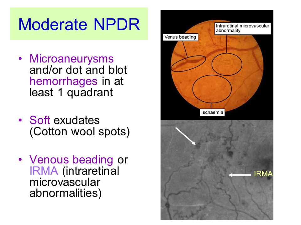 Moderate NPDR Microaneurysms and/or dot and blot hemorrhages in at least 1 quadrant. Soft exudates (Cotton wool spots)