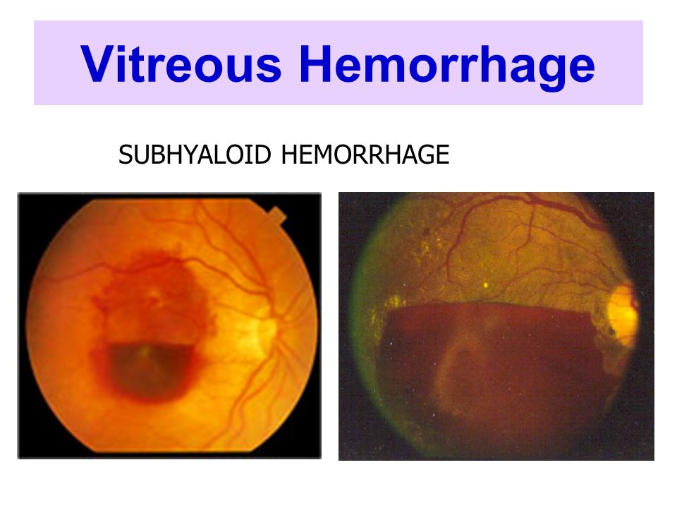 Vitreous Hemorrhage SUBHYALOID HEMORRHAGE