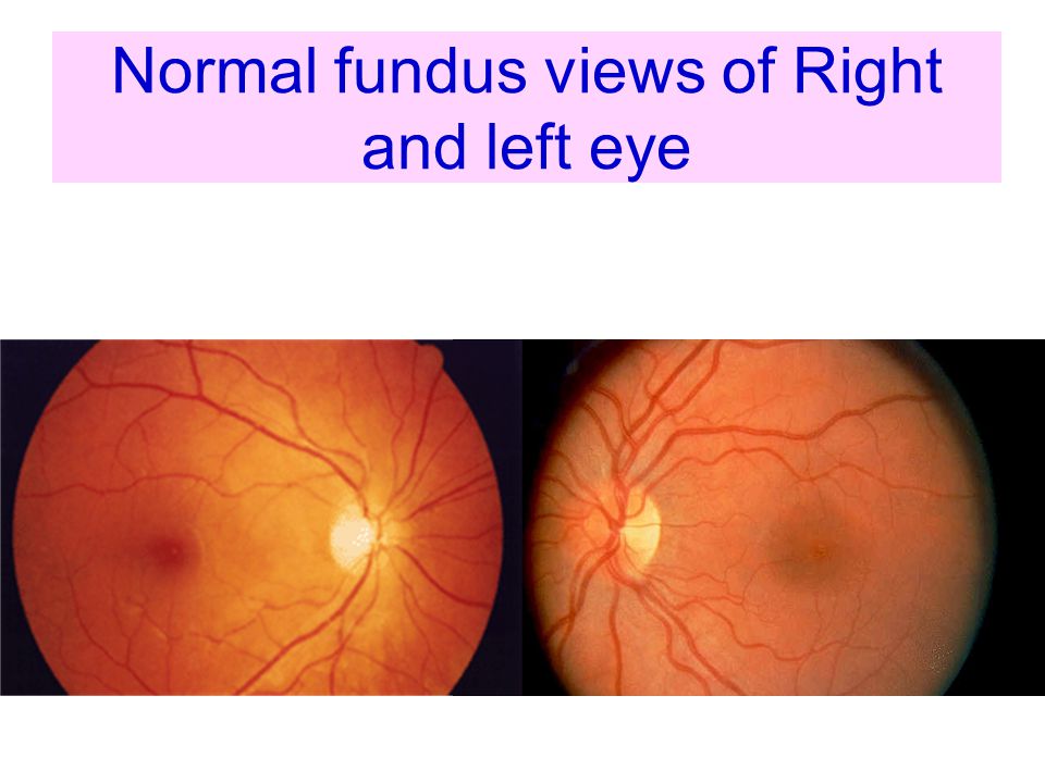 Normal fundus views of Right and left eye