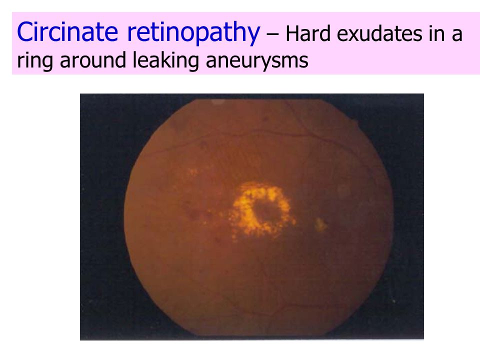 Circinate retinopathy – Hard exudates in a ring around leaking aneurysms