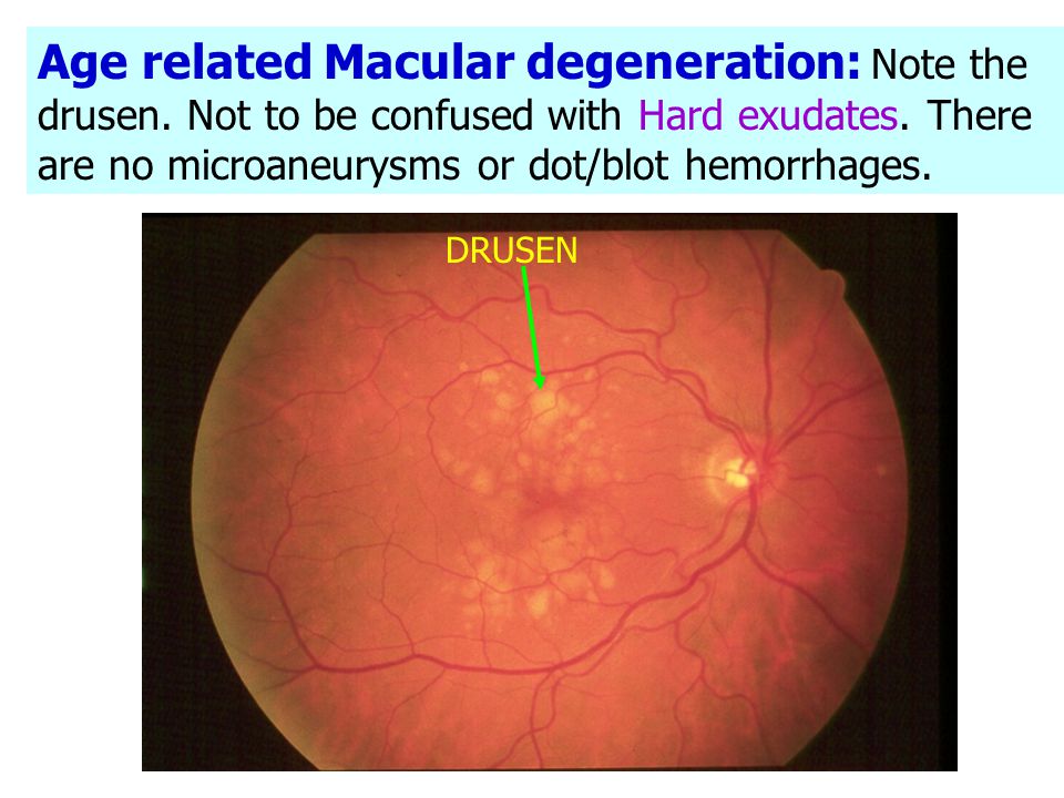 Age related Macular degeneration: Note the drusen