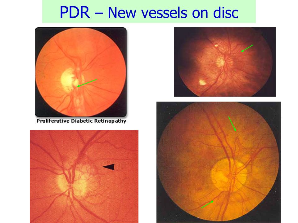 PDR – New vessels on disc