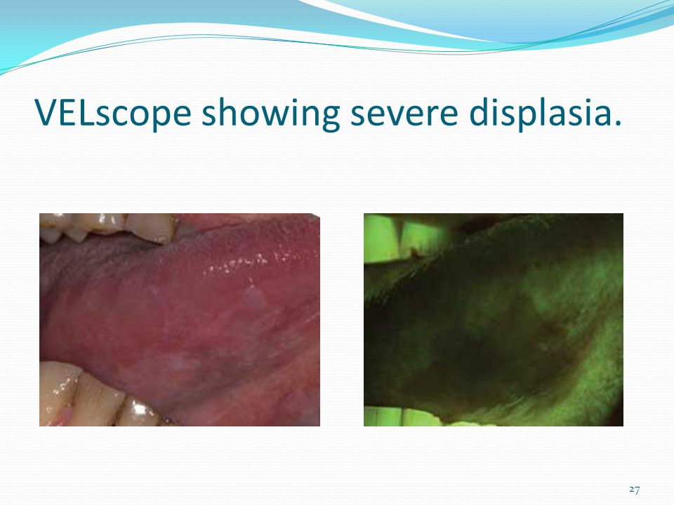VELscope showing severe displasia.