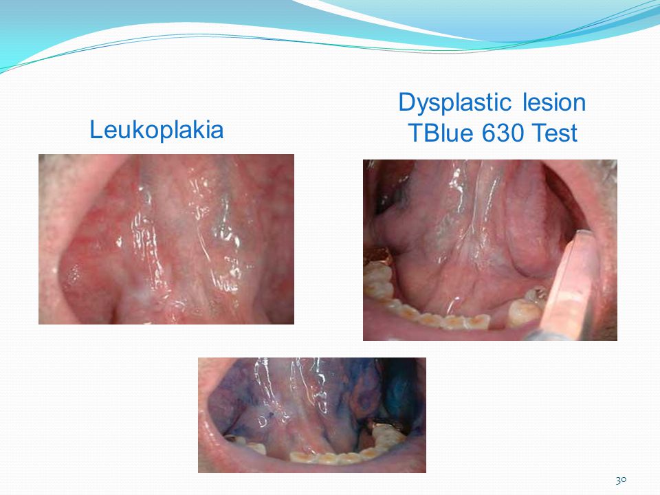 Dysplastic lesion TBlue 630 Test